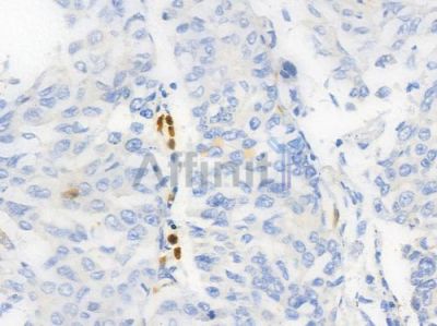 AurB Antibody - AF6475 at 1/100 staining human lung squamous cell carcinoma by IHC-P.