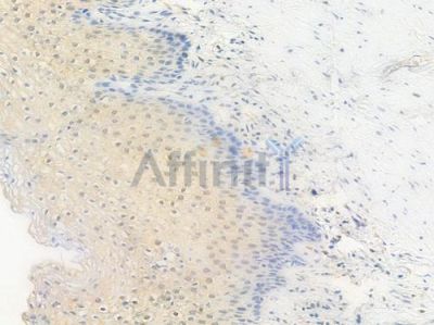 SIRT6 Antibody - AF6571 at 1/100 staining human cervical carcinoma by IHC-P.