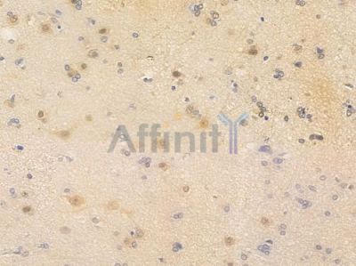 TDP43 Antibody - AF6832 at 1/100 staining human glioblastoma by IHC-P.
