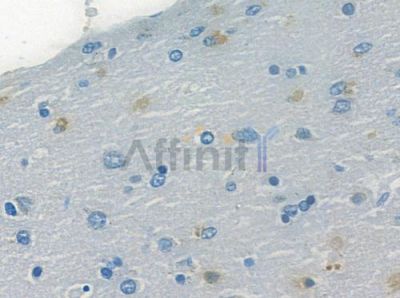 Phospho-osterix (Thr319) Antibody - AF7080 at 1/100 staining human glioblastoma by IHC-P.