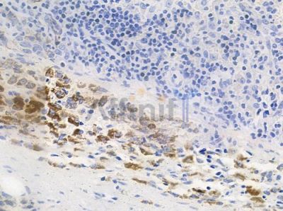 Phospho-Doublecortin (Ser332) Antibody - AF7127 at 1/100 staining human melanoma by IHC-P.