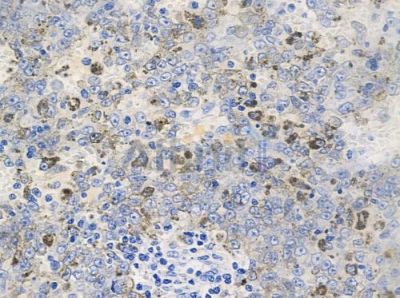 Phospho-ATP citrate lyase (Thr447) Antibody - AF7323 at 1/100 staining human renal cell carcinoma by IHC-P.