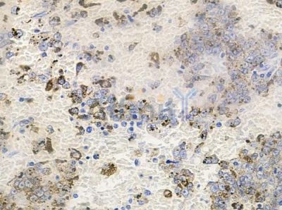 Phospho-PSD95 (Ser142) Antibody - AF7339 at 1/100 staining human melanoma by IHC-P.