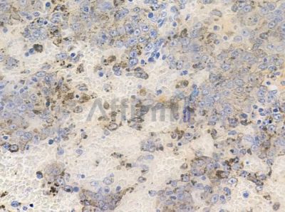 Phospho-CTDSPL2 (Ser9) Antibody - AF7352 at 1/100 staining human melanoma by IHC-P.