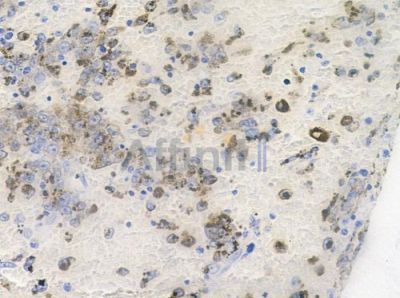 Phospho-SQSTM1/p62 (Ser266) Antibody - AF7375 at 1/100 staining human melanoma by IHC-P.