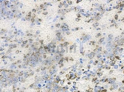 Phospho-NuMA (Ser169) Antibody - AF7390 at 1/100 staining human melanoma by IHC-P.