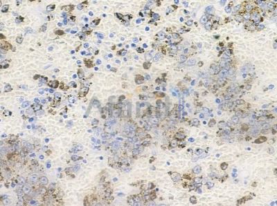 Phospho-TACC3 (Tyr560) Antibody - AF7444 at 1/100 staining human melanoma by IHC-P.