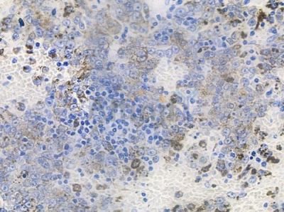 Phospho-Doublecortin (Ser297) Antibody - AF8025 at 1/100 staining human melanoma by IHC-P.