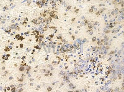 Phospho-Smad1 (Ser214) Antibody - AF8058 at 1/100 staining human melanoma by IHC-P.