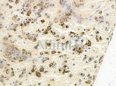 Phospho-HAND1 (Ser98) Antibody - AF8063 at 1/100 staining human melanoma by IHC-P.