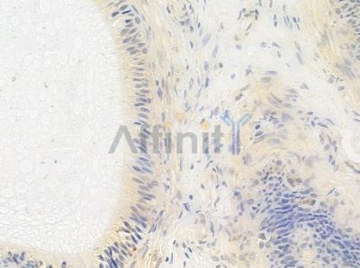 Phospho-TOP2A (Ser1213) Antibody - AF8090 at 1/100 staining human testicular cancer by IHC-P.