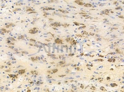 Phospho-CDX2 (Ser283) Antibody - AF8253 at 1/100 staining human melanoma by IHC-P.