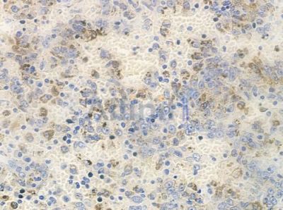 Phospho-PAK6 (Ser165) Antibody - AF8297 at 1/100 staining human melanoma by IHC-P.