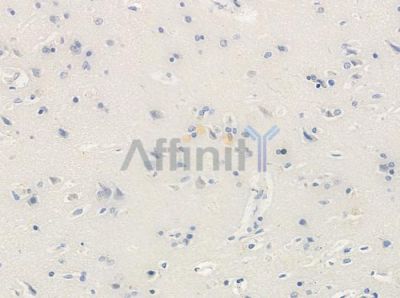 Phospho-TRAP220/MED1 (Thr1032) Antibody - AF8302 at 1/100 staining human glioblastoma by IHC-P.