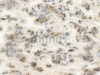 Phospho-KAT13A/SRC1 (Thr1179) Antibody - AF8319 at 1/100 staining human melanoma by IHC-P.