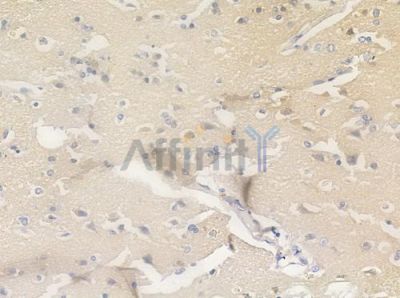 Phospho-53BP1 (Ser1778) Antibody - AF8337 at 1/100 staining human glioblastoma by IHC-P.