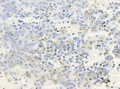 Phospho-EPHA7 (Tyr608) Antibody - AF8428 at 1/100 staining human melanoma by IHC-P.