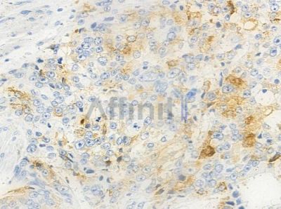 Phospho-Smad1/9 (Ser463/Ser465) Antibody - AF8454 at 1/100 staining human prostate carcinoma by IHC-P.