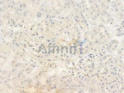 Phospho-YB1 (Ser102) Antibody - AF8525 at 1/100 staining human renal cell carcinoma by IHC-P.