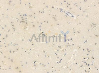 Phospho-YB1 (Ser102) Antibody - AF8525 at 1/100 staining human glioblastoma by IHC-P.