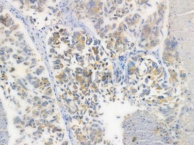 BTBD6 Antibody - AF9026 at 1/100 staining human lung squamous cell carcinoma by IHC-P.
