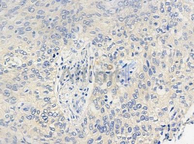 CD158f2 Antibody - AF9037 at 1/100 staining human cervical carcinoma by IHC-P.