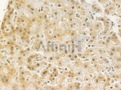 HoxD8 Antibody - AF9090 at 1/100 staining human hepatocellular carcinoma by IHC-P.