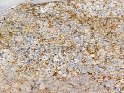 LONP2 Antibody - AF9105 at 1/100 staining human prostate carcinoma by IHC-P.