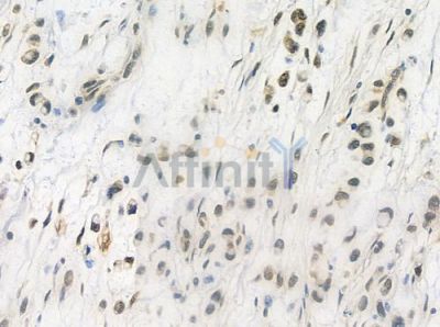 NIPA Antibody - AF9132 at 1/100 staining human gastric carcinoma by IHC-P.
