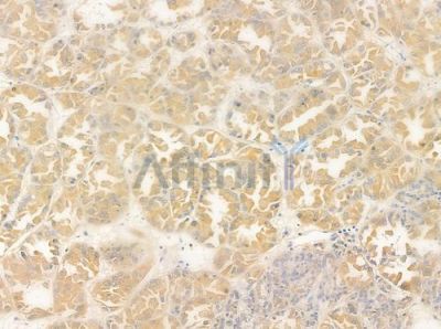 Olfactory receptor 51I1 Antibody - AF9142 at 1/100 staining human renal cell carcinoma by IHC-P.