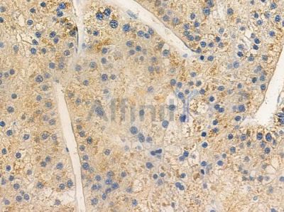 PIPOX Antibody - AF9160 at 1/100 staining human hepatocellular carcinoma by IHC-P.