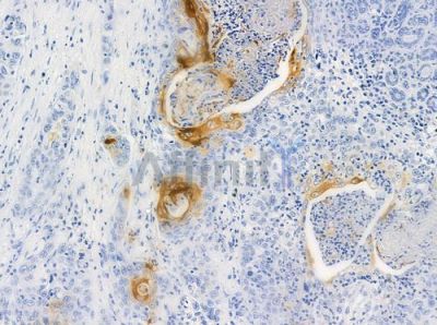 RHOBTB3 Antibody - AF9183 at 1/100 staining human esophageal carcinoma by IHC-P.