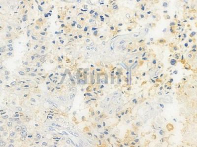 Septin 1 Antibody - AF9196 at 1/100 staining human prostate carcinoma by IHC-P.