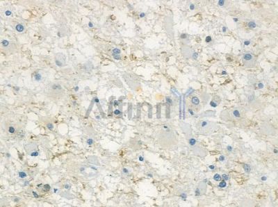 Septin 8 Antibody - AF9197 at 1/100 staining human melanoma by IHC-P.