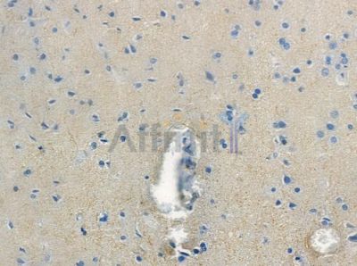 Septin 8 Antibody - AF9197 at 1/100 staining human glioblastoma by IHC-P.