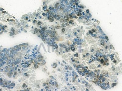 Sp3/4 Antibody - AF9200 at 1/100 staining human melanoma by IHC-P.