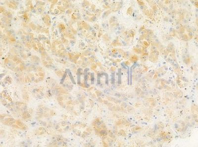 WAVE4 Antibody - AF9230 at 1/100 staining human renal cell carcinoma by IHC-P.