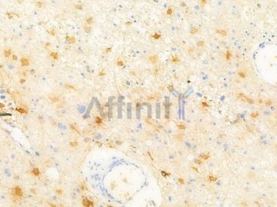 WAVE4 Antibody - AF9230 at 1/100 staining human astrocytoma by IHC-P.