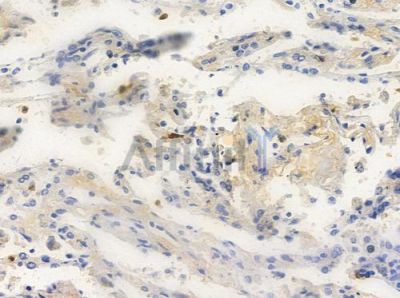 GOLT1A Antibody - DF10008 at 1/100 staining human lung squamous cell carcinoma by IHC-P.