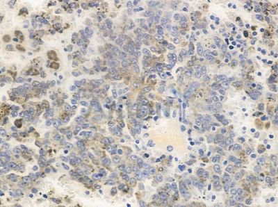 CCNI Antibody - DF10025 at 1/100 staining human melanoma by IHC-P.