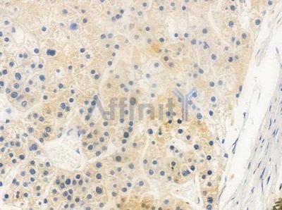 MAGBI Antibody - DF10039 at 1/100 staining human hepatocellular carcinoma by IHC-P.