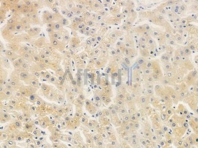 MAGBI Antibody - DF10039 at 1/100 staining human hepatocellular carcinoma by IHC-P.