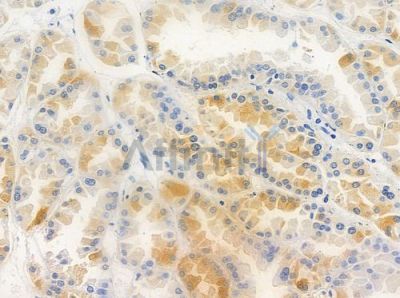 TSH3 Antibody - DF10052 at 1/100 staining human renal cell carcinoma by IHC-P.
