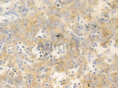 CYFIP1 Antibody - DF10059 at 1/100 staining human melanoma by IHC-P.