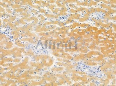 TRMT11 Antibody - DF10060 at 1/100 staining human hepatocellular carcinoma by IHC-P.