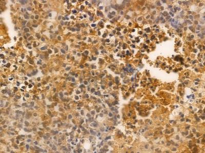TSC-22R Antibody - DF10077 at 1/100 staining human glioblastoma by IHC-P.