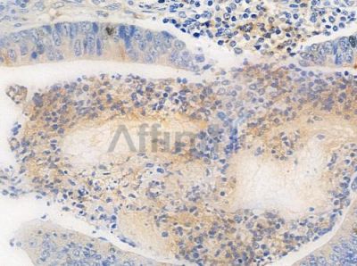 RTDR1 Antibody - DF10086 at 1/100 staining human colon carcinoma by IHC-P.