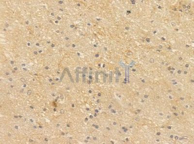 DEDD Antibody - DF10100 at 1/100 staining human glioblastoma by IHC-P.