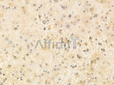 DEDD Antibody - DF10100 at 1/100 staining human astrocytoma by IHC-P.