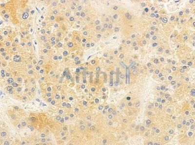 IL22RA2 Antibody - DF10107 at 1/100 staining human hepatocellular carcinoma by IHC-P.